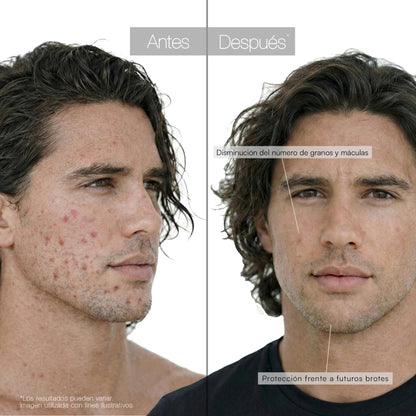 Moisturising Acne Spot Care Serum